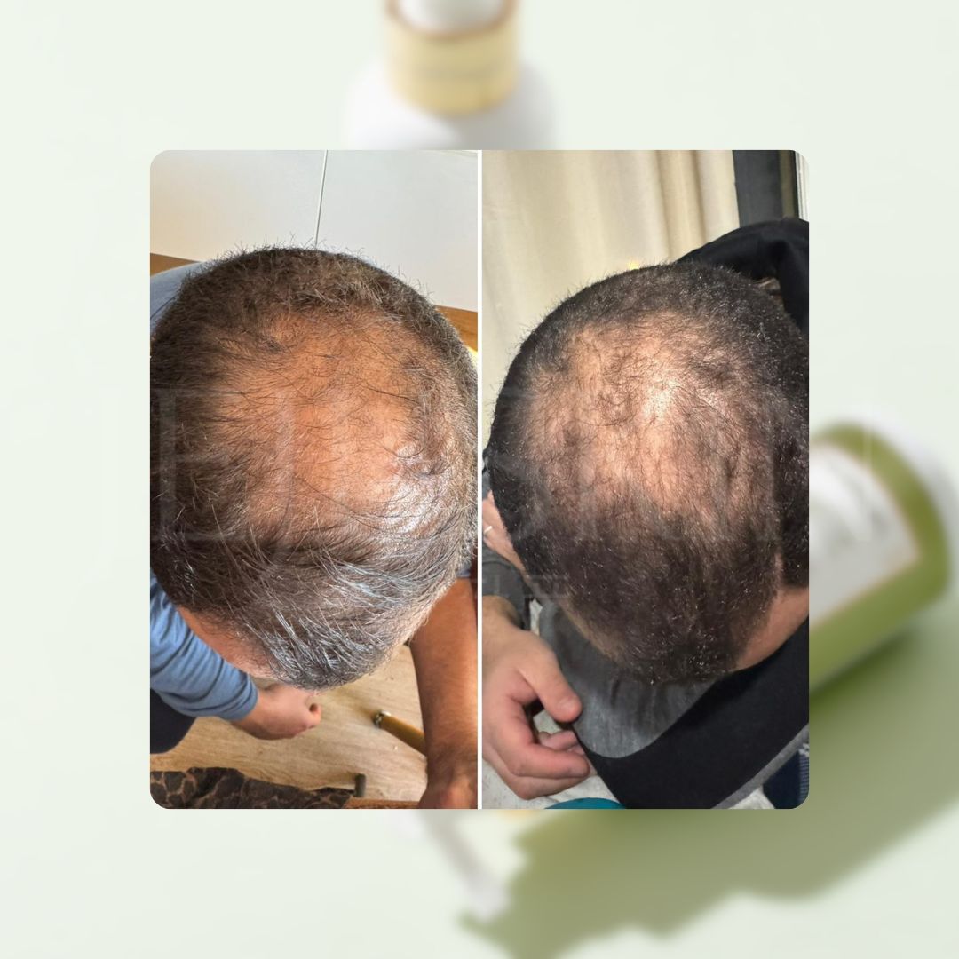 Avant après montrant l'évolution de la chute de cheveux avec le toner cell happy co