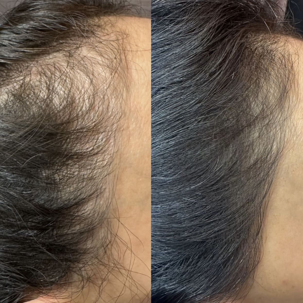 Avant après Some By Mi Soin traitement du cuir chevelu et anti-chute de cheveux Cica Peptide