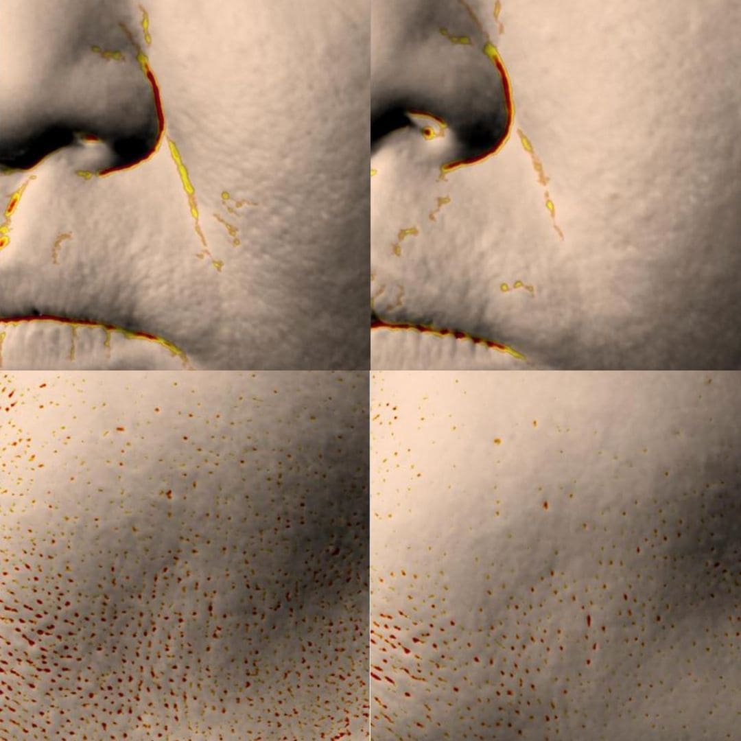 Après 1 utilisation du masque sungboon sur les pores