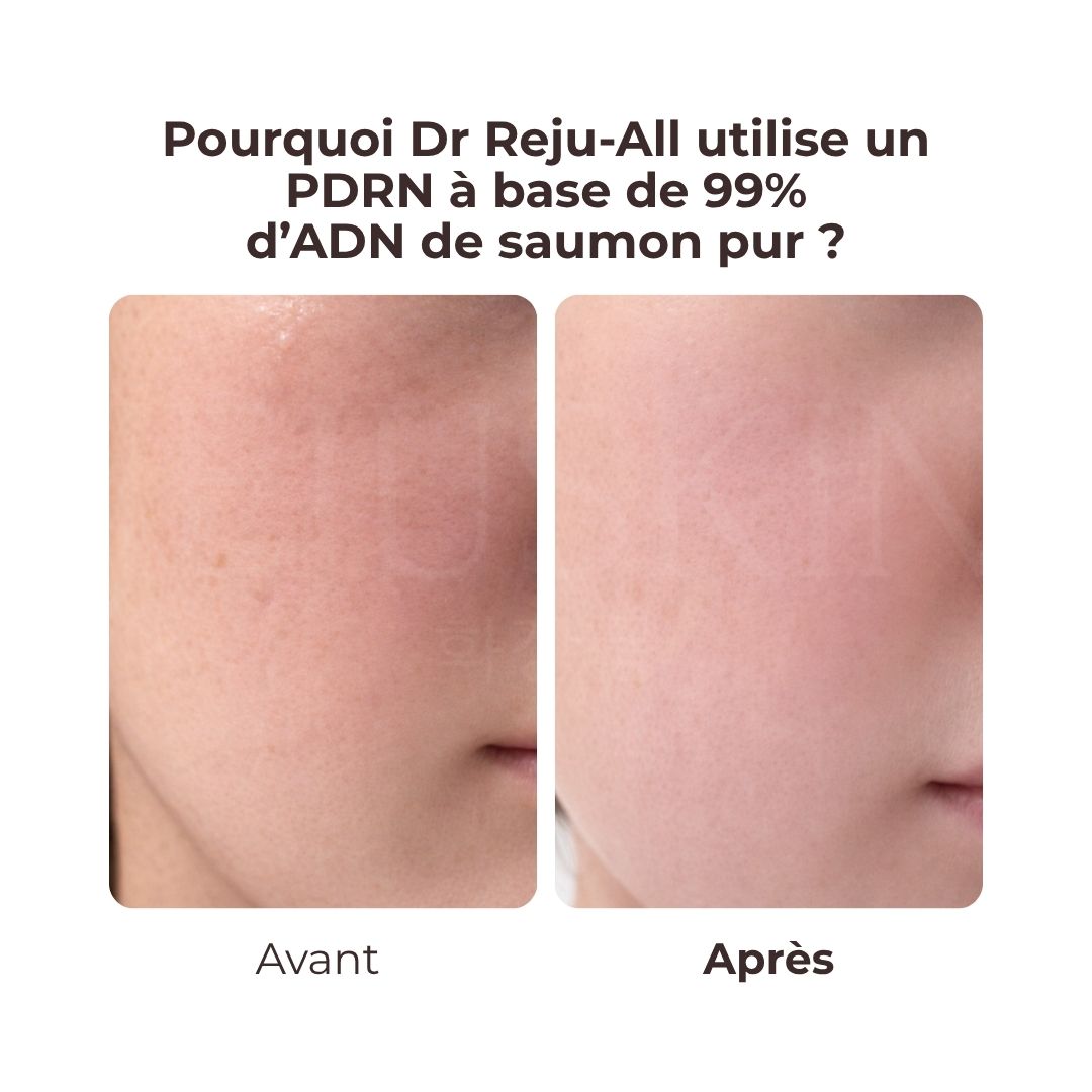 Avant après utilisé la crème hydratante et régénérante au PDRN de Dr. Reju-All 
