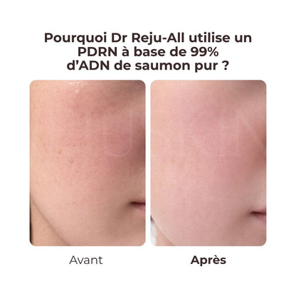 Avant après utilisé la crème hydratante et régénérante au PDRN de Dr. Reju-All 