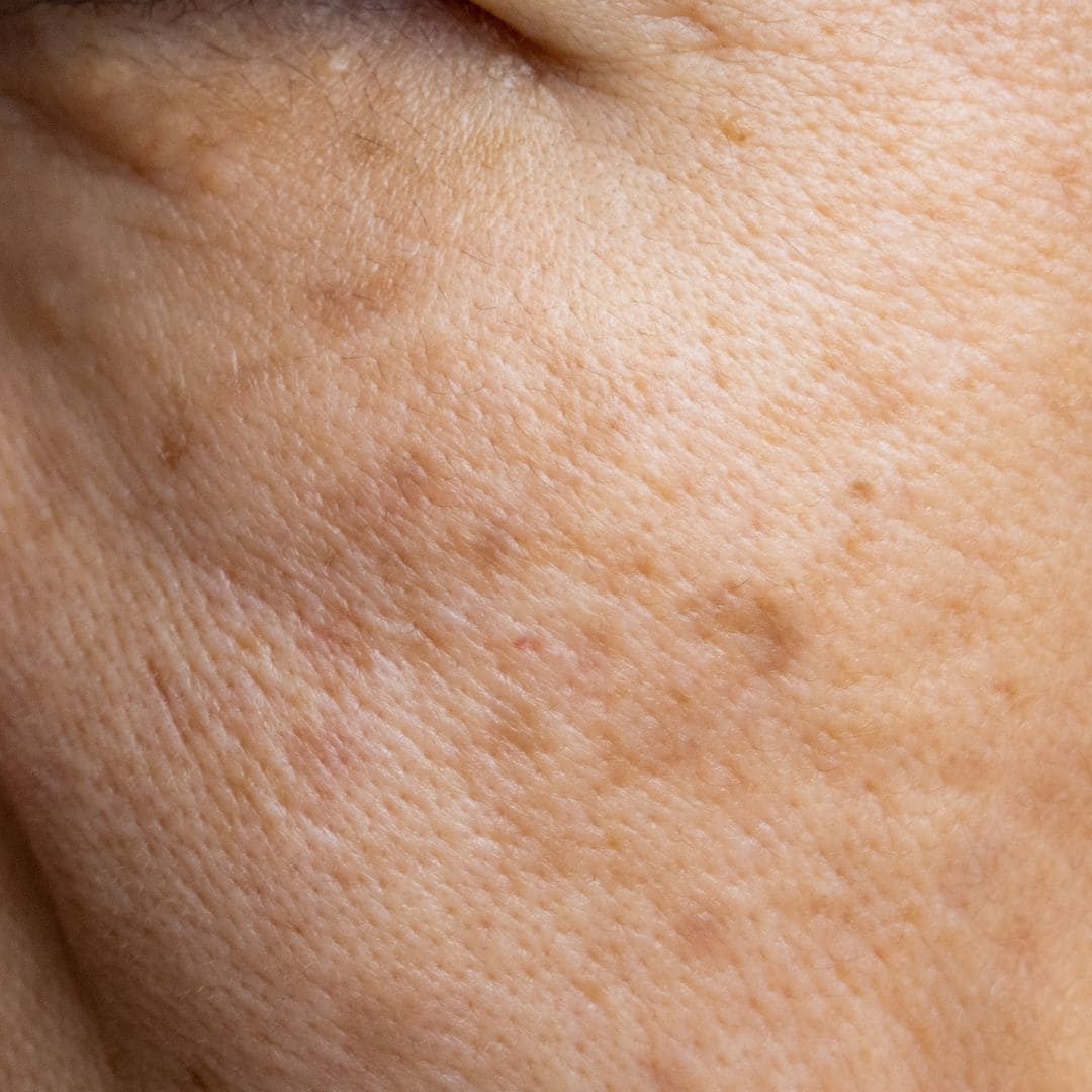 Les tâches brunes sur un visage