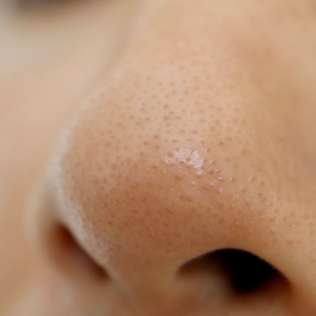Brosse ilso pour les pores et le sebum