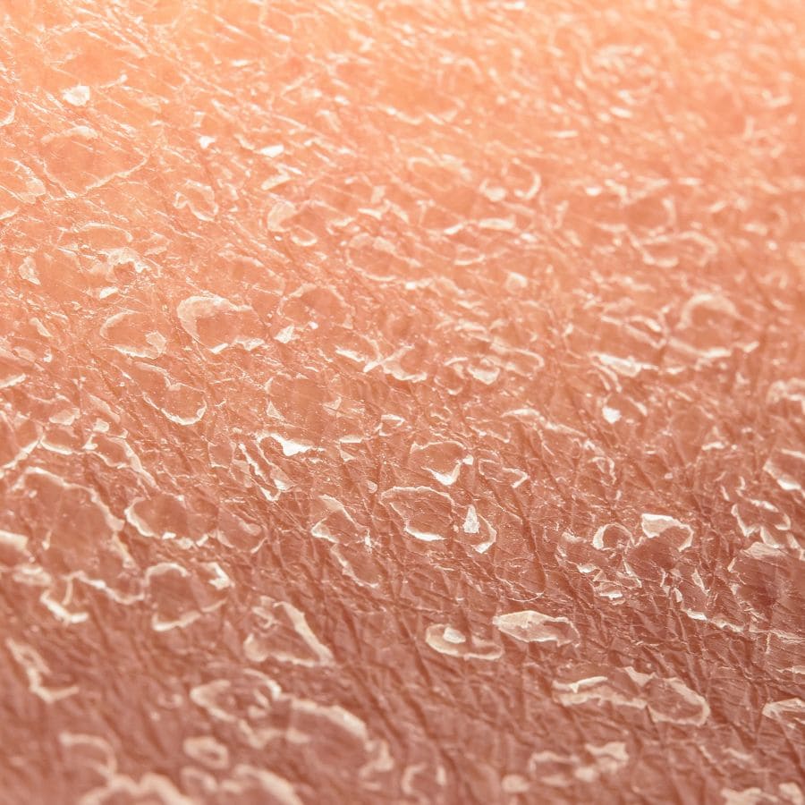 Image d'une peau très sèche