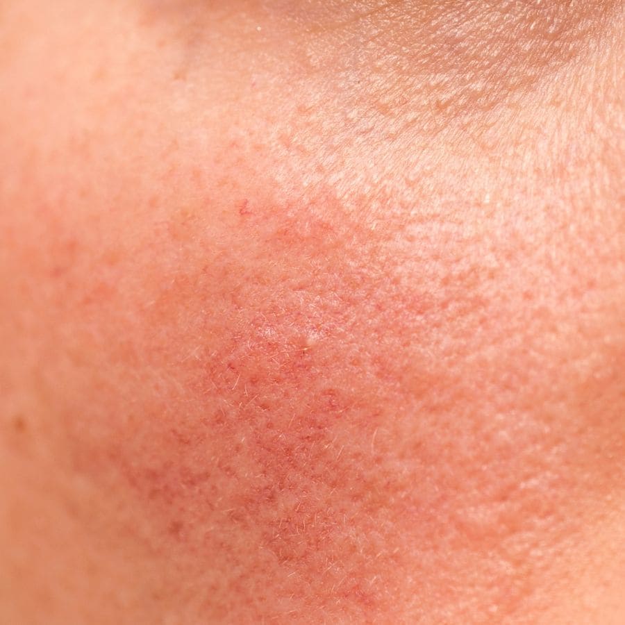 Rougeurs sur le visage