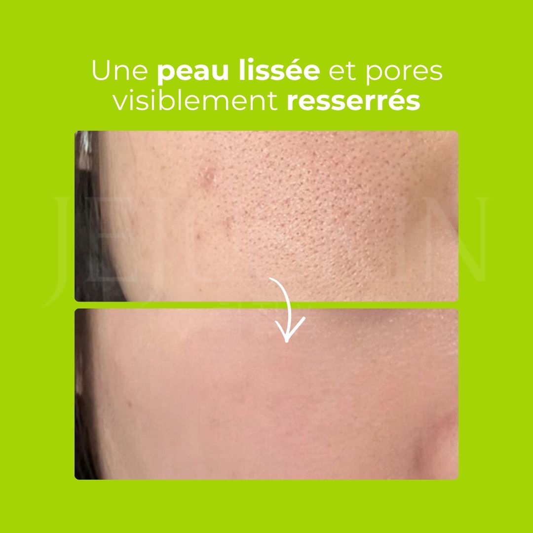 Avant après utilisation du gel exfoliant au lait de haricot mungo de Beplain