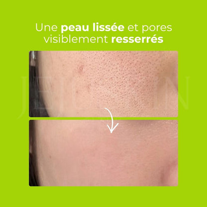 Avant après utilisation du gel exfoliant au lait de haricot mungo de Beplain