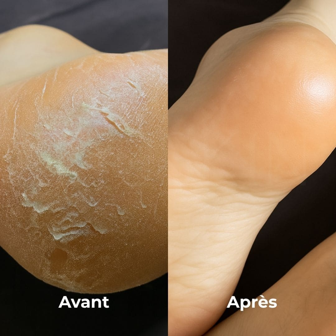 Baren Kit adoucissant pour les pieds avant après
