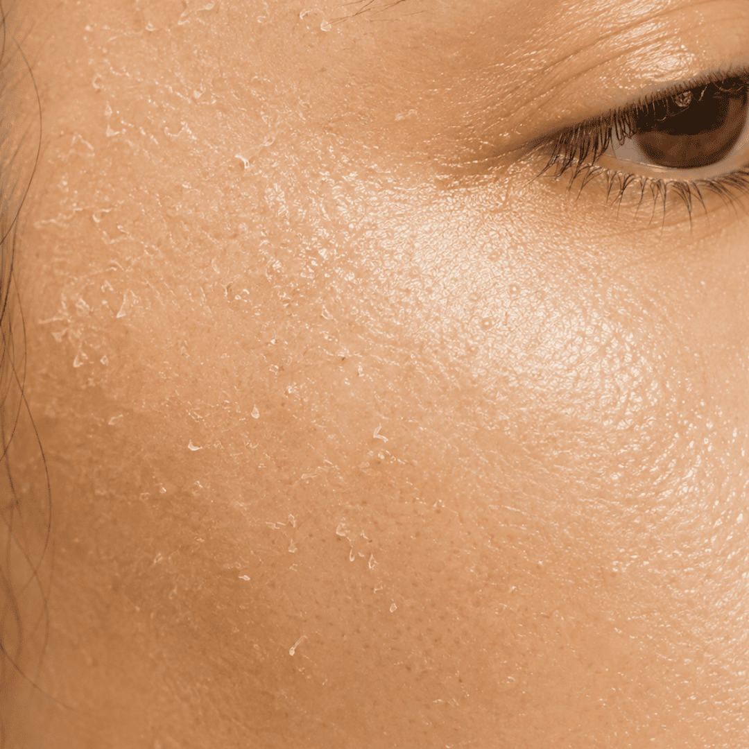 Peaux mortes sur le visage d'une femme