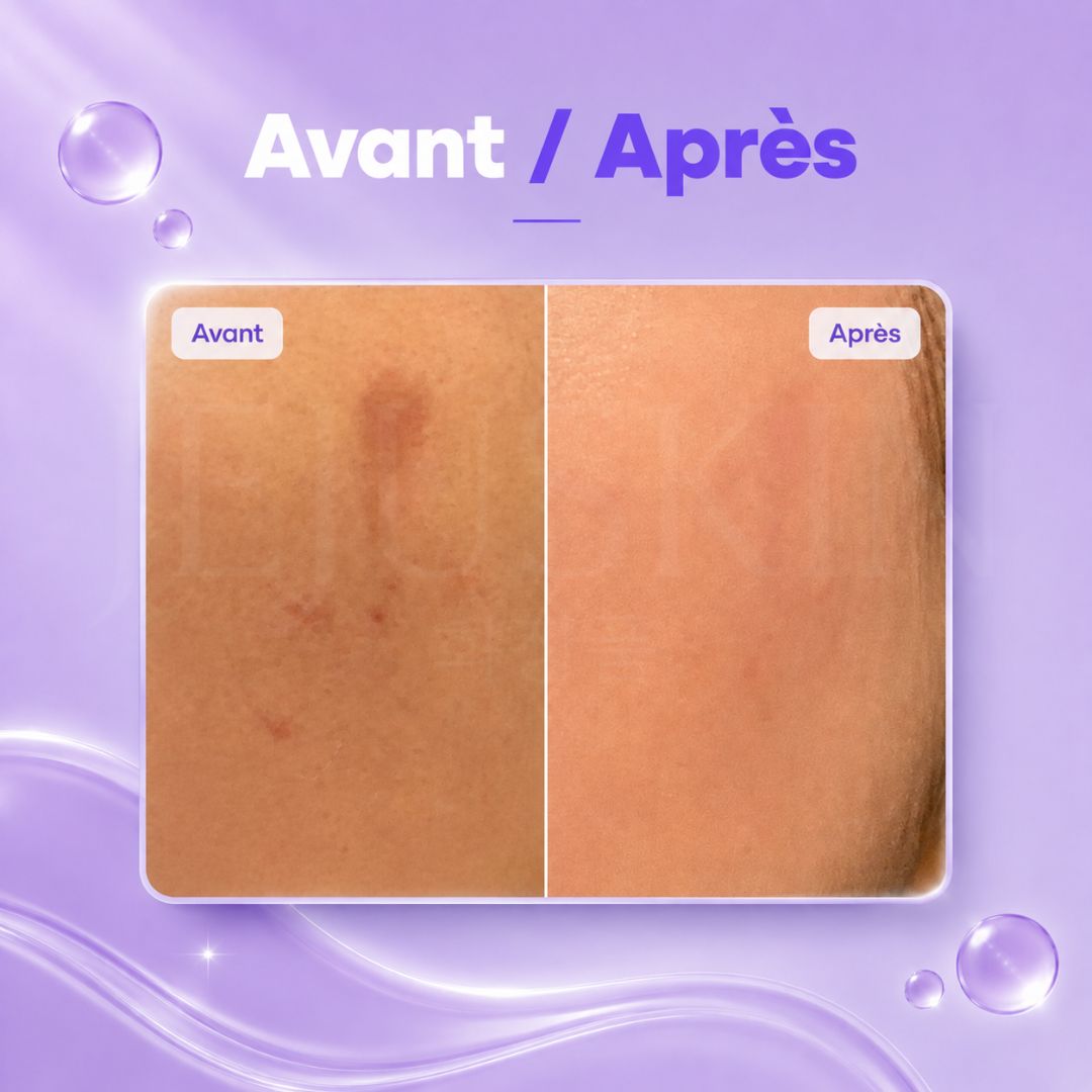 Avant après utilisation du sérum anti-taches B-Boost à 1% d’acide kojique de Nineless