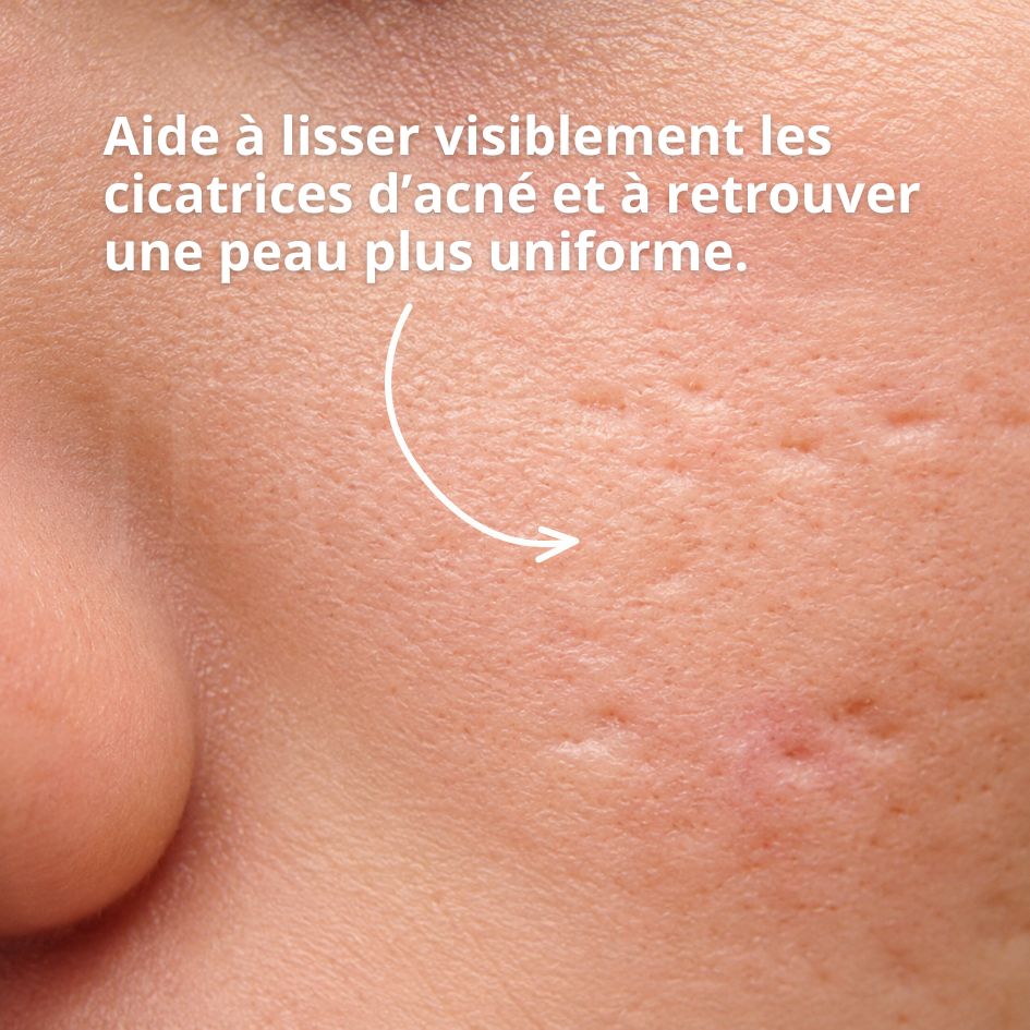 Le gel réparateur pour cicatrices et imperfections de noscarna efficace contre les cicatrices