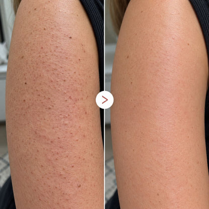 Avant après utilisation de l'exfoliant pour le corps à l’acide hypochloreux de Medicube