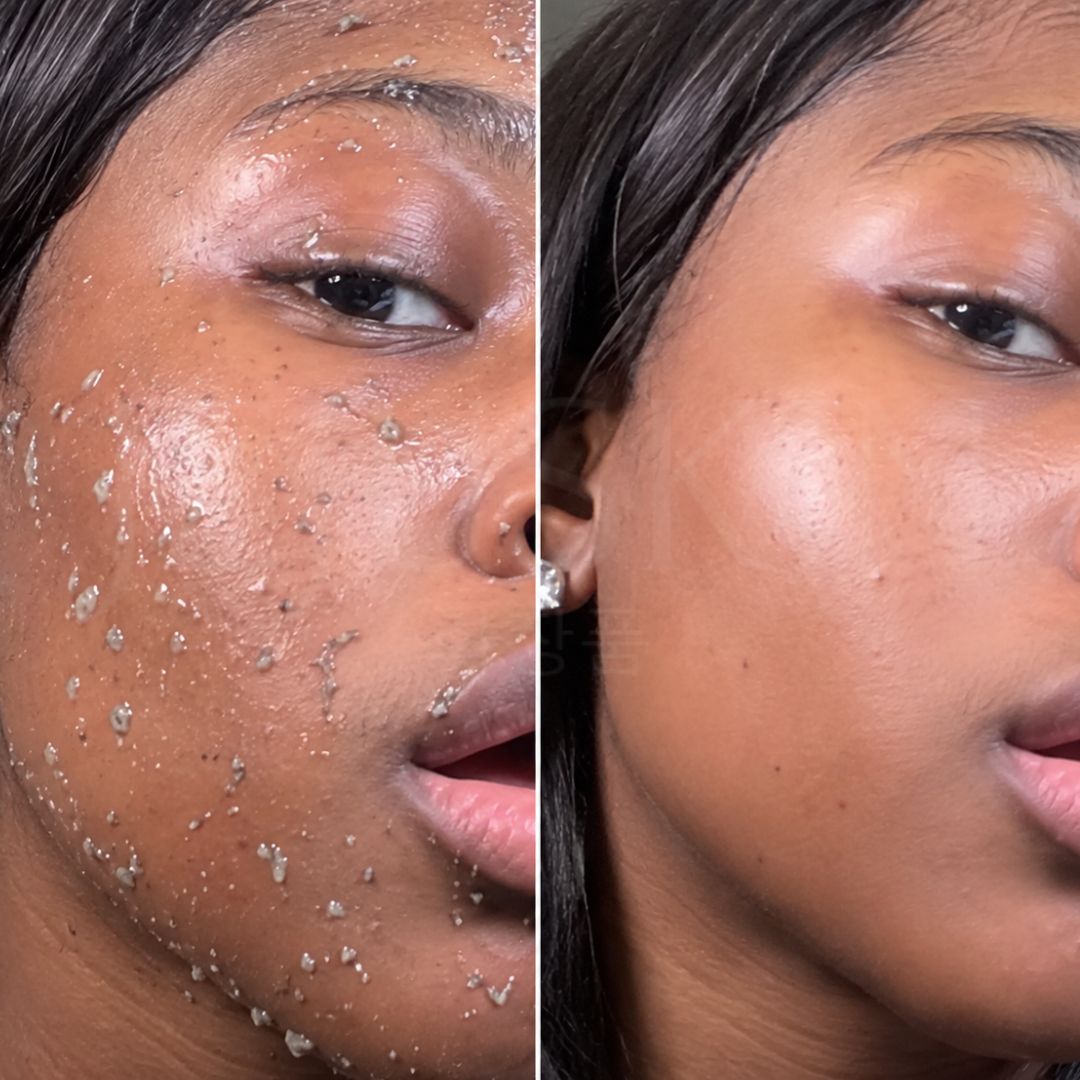 Avant après utilisation de l'exfoliant visage doux à l’acide hypochloreux de Medicube