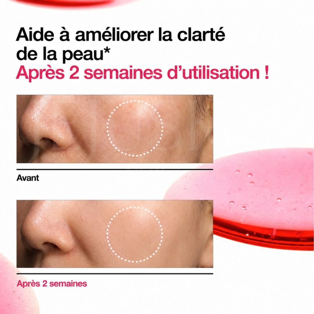 Anua Sérum anti-tâches à la Niacinamide 10% + TXA 4% résultat avant après