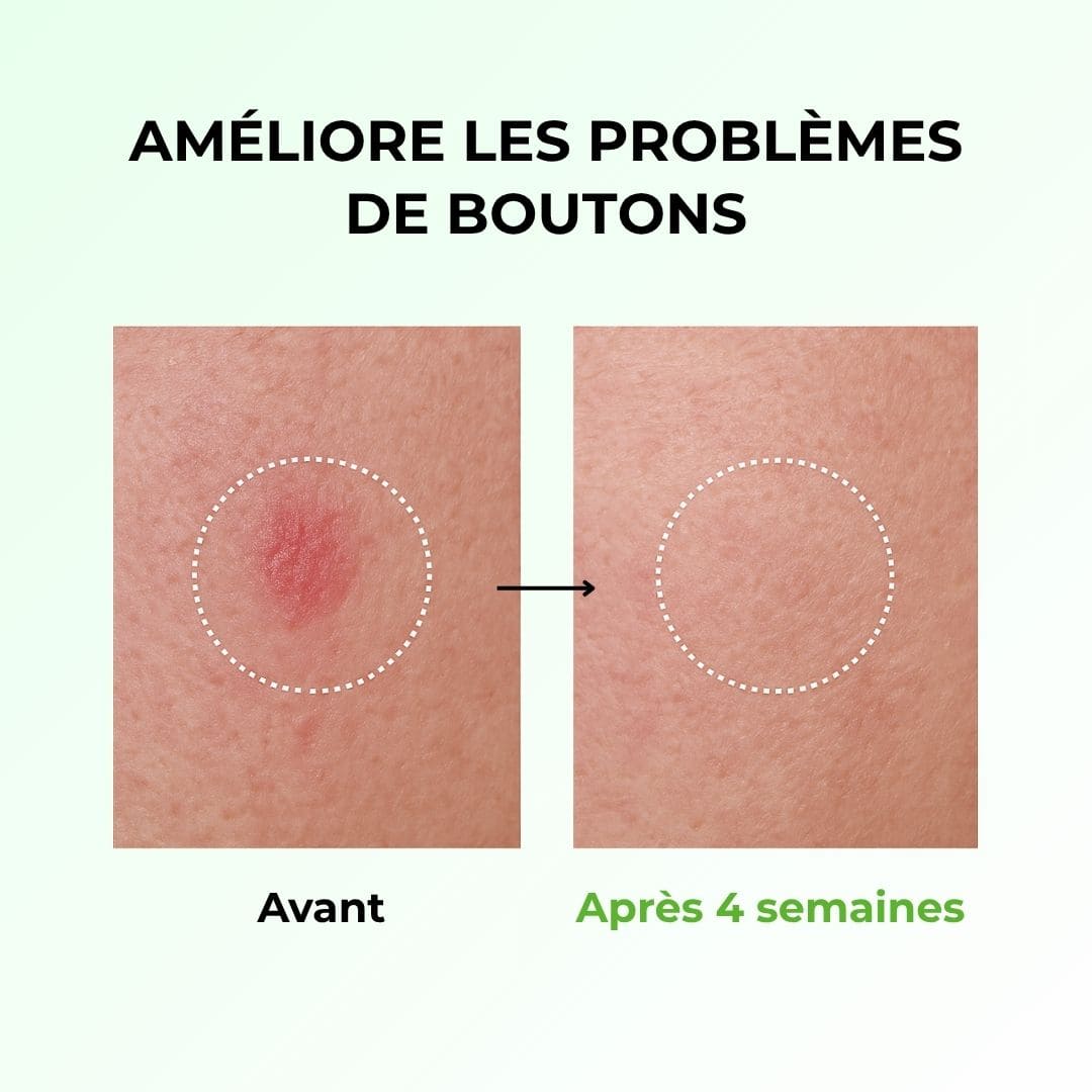 Anua toner apaisant à l’acide azélaïque 3% et à la Centella Cica avant après