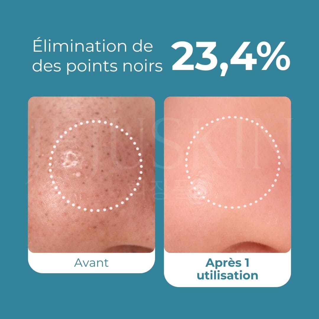 Avant Après avoir utilisé l'huile nettoyante zero pore de Medicube
