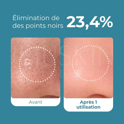 Avant Après avoir utilisé l'huile nettoyante zero pore de Medicube