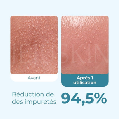 Avant Après de l'huile nettoyante anti-points noirs Zero Pore de Medicube