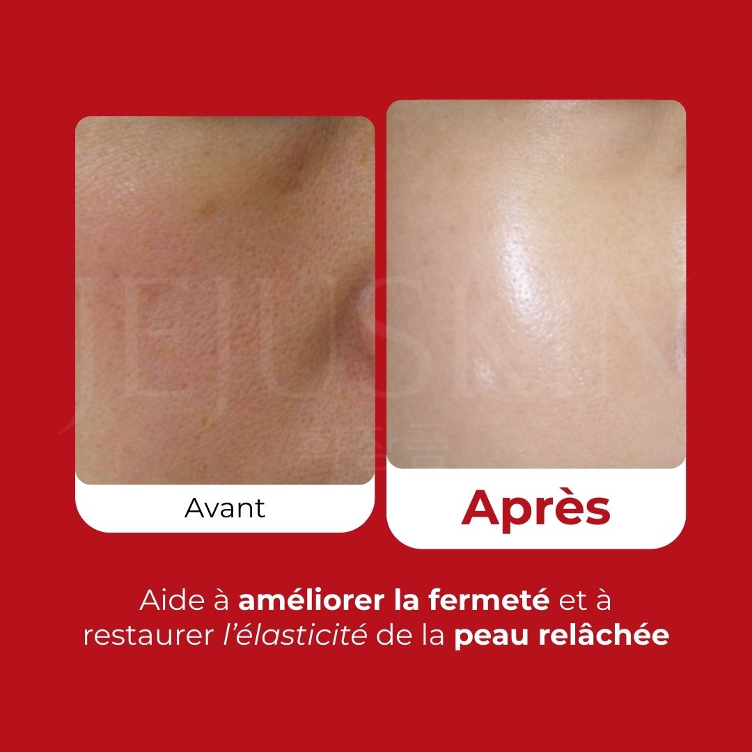 Avant après 2 de la crème Medi-Peel au collagène