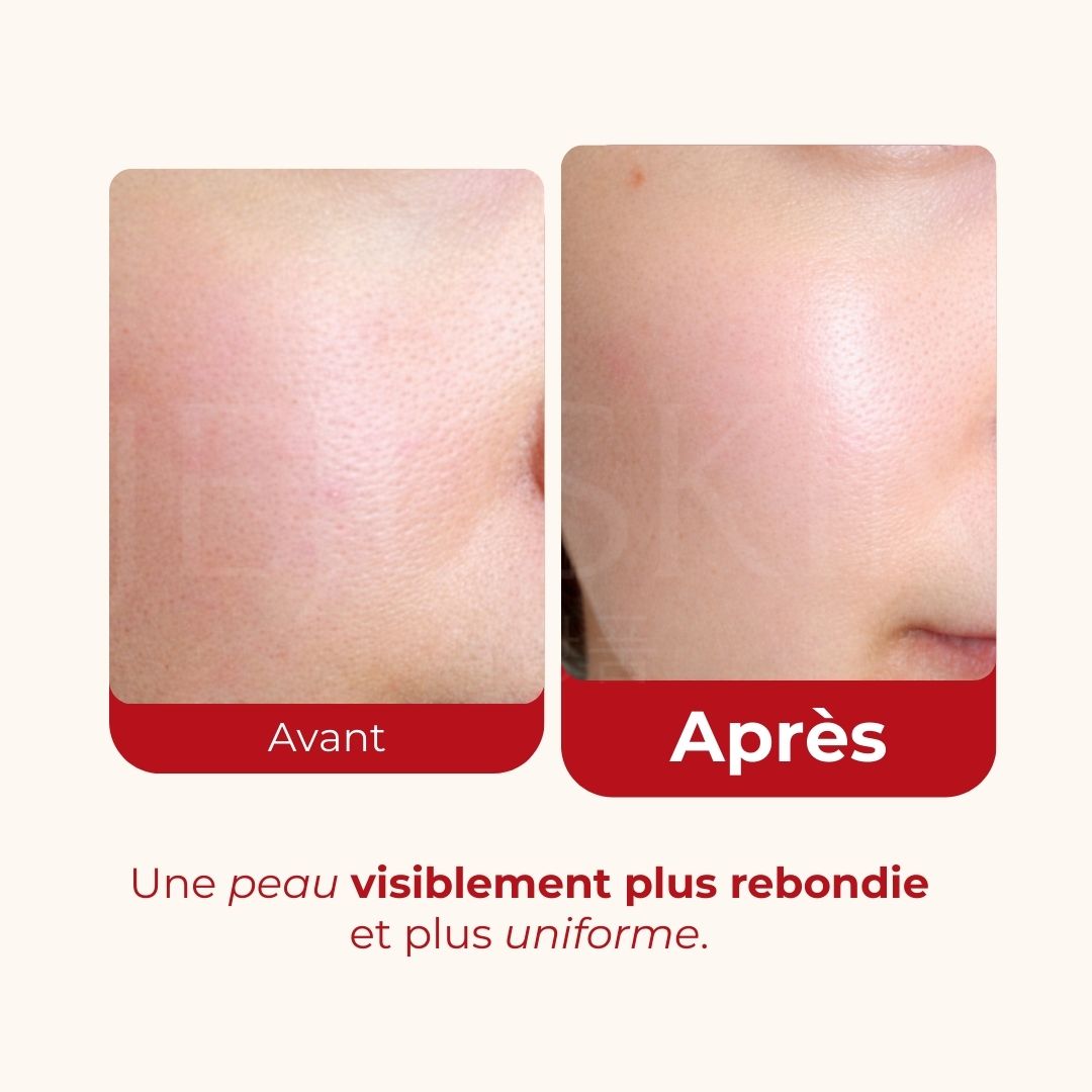 Avant après de la crème Medi-Peel au collagène