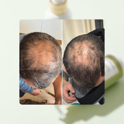 Avant après montrant l'évolution de la chute de cheveux avec le toner cell happy co