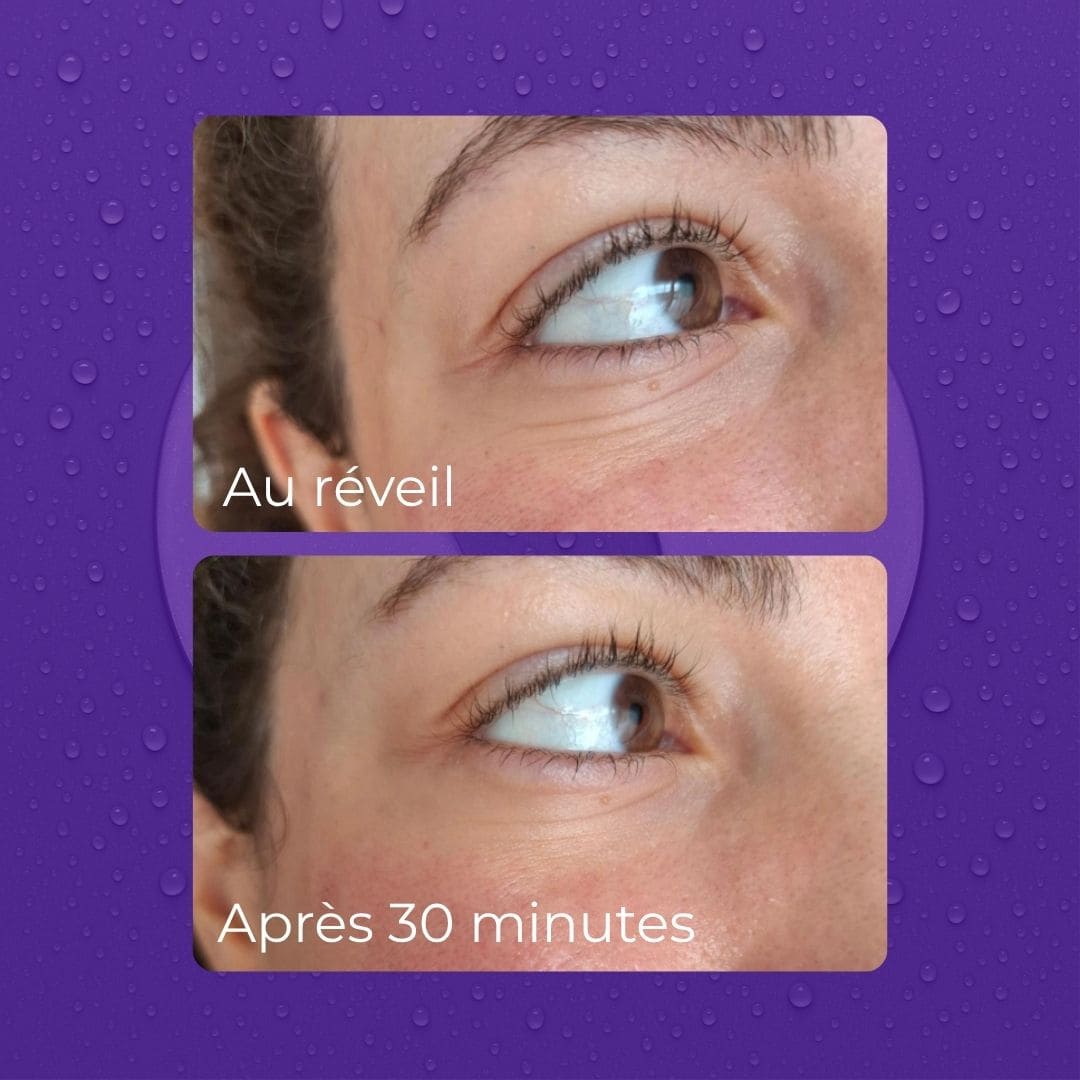 Avant après patchs mizon