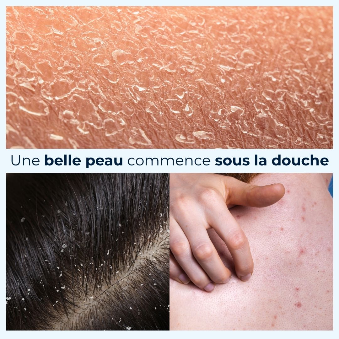 Bénéfices pour la peau du pommeau onsha