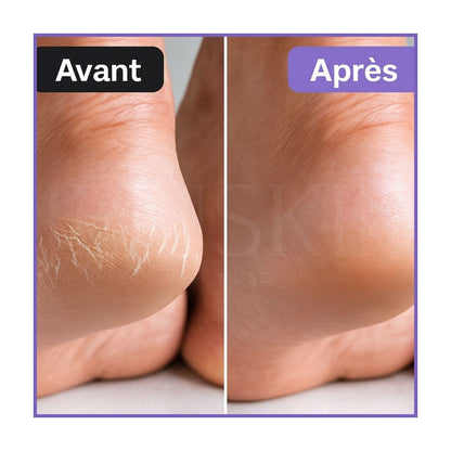 Baren Patchs de nuit réparateurs pour les talons au beurre de karité avant après