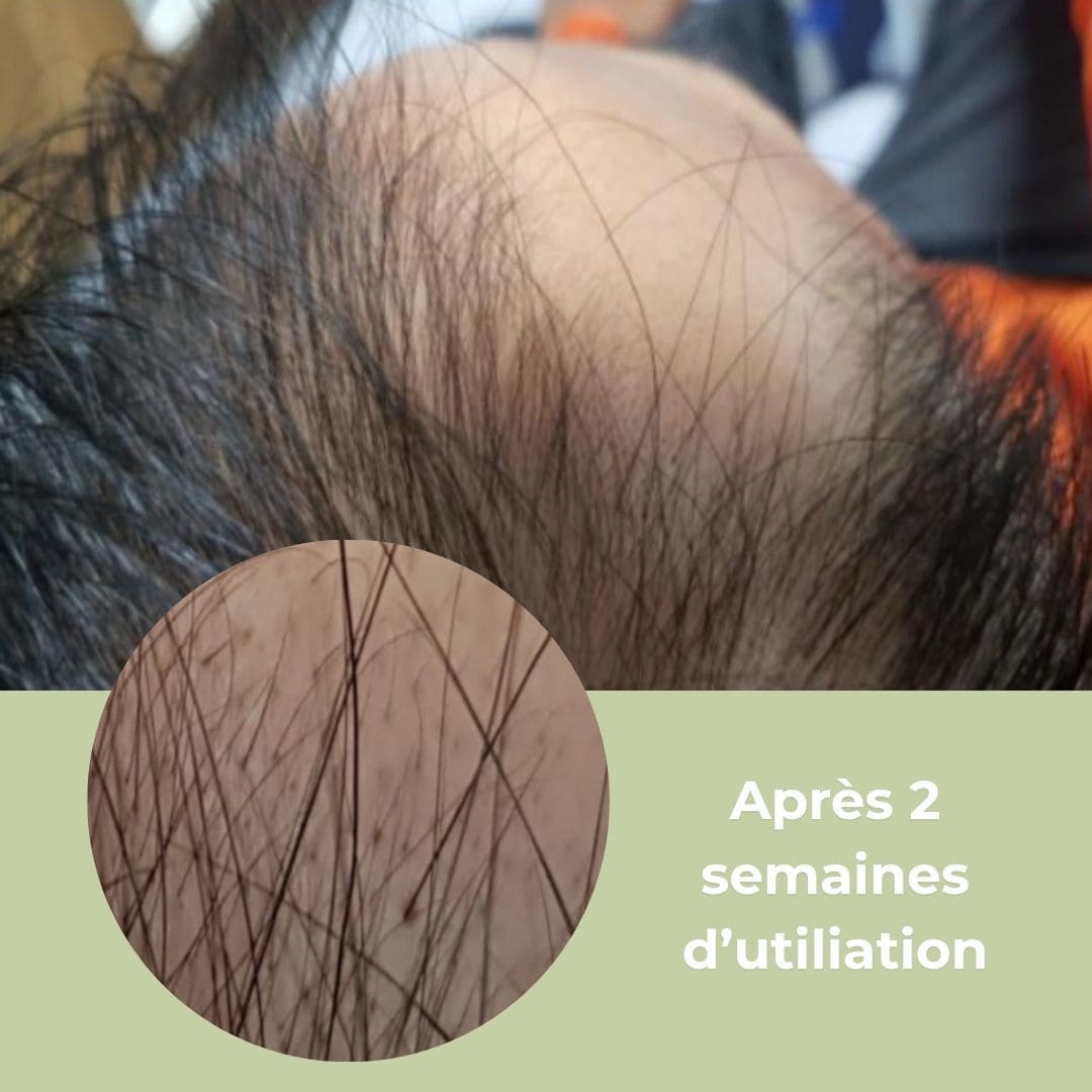 Photo du cuir chevelu avant et après application du toner.