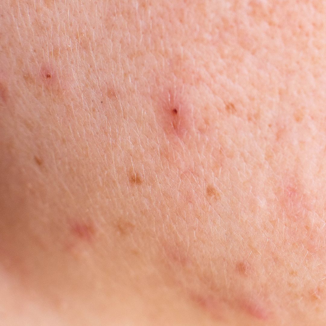 Acné sur un visage