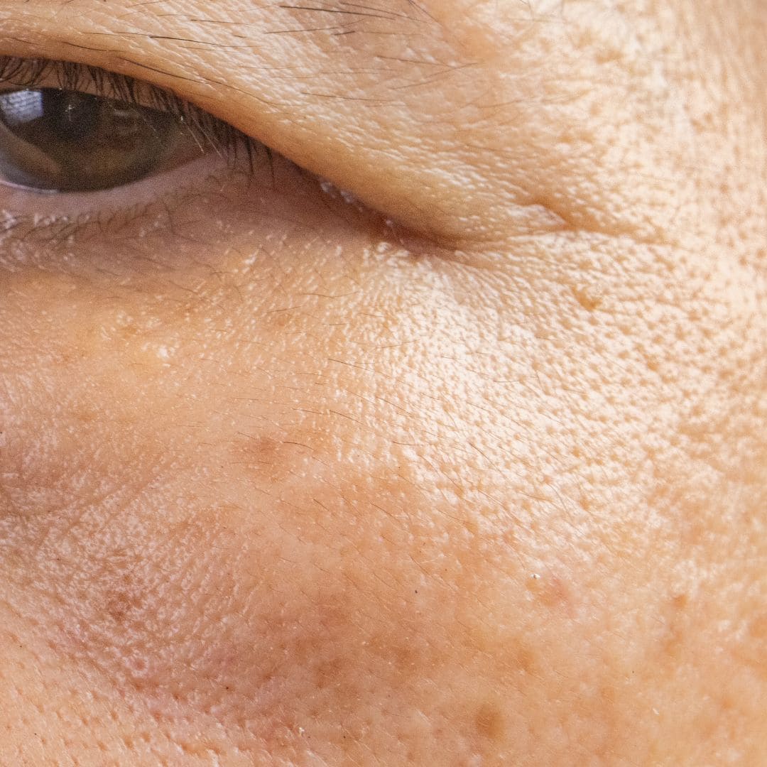 Tâches brunes sur le visage d'une femme