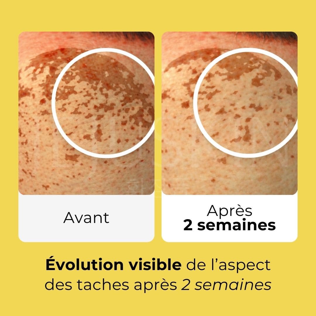 Image d'un avant après sur des taches de la crème capsules d'alba