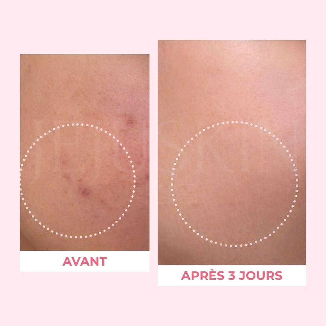 Une image des avant après de la crème capsules de Medicube